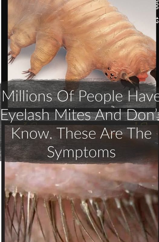 How To Detect And Eliminate Eyelash Mites (Demodex Mites) - Weveryday
